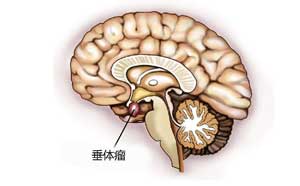 腦垂體瘤治療
