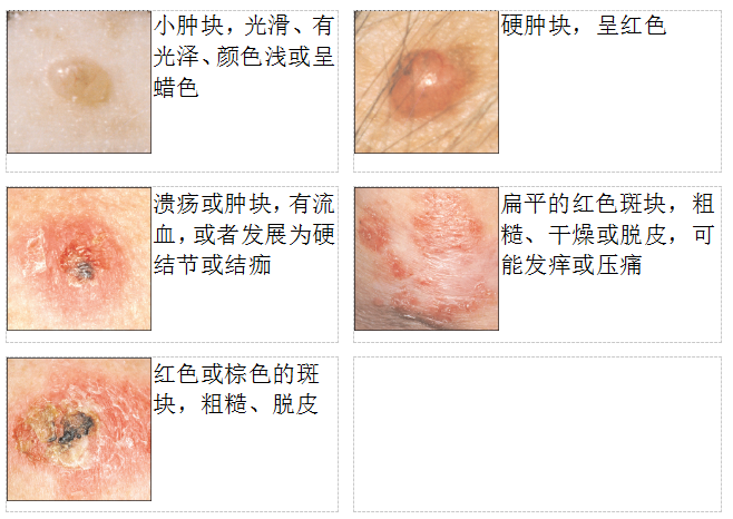 “基底細(xì)胞癌”的圖片搜索結(jié)果