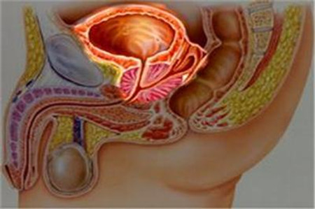 日本治療膀胱癌