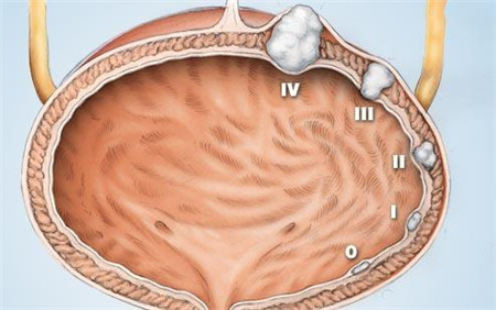 日本治療膀胱癌