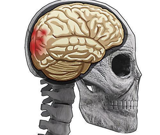 日本腦出血治療方法