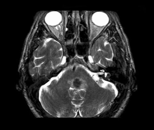 日本腦出血治療方法