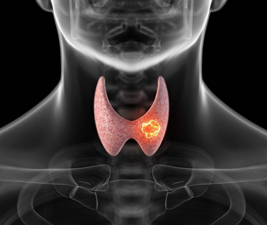 日本甲狀腺治療方法