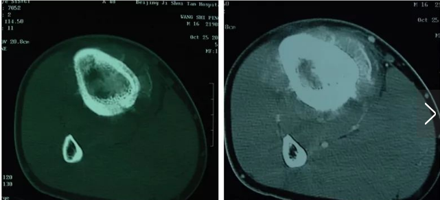 日本骨肉瘤治療方法