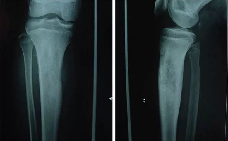 日本骨肉瘤治療方法
