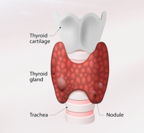 美國(guó)治療甲狀腺腫瘤