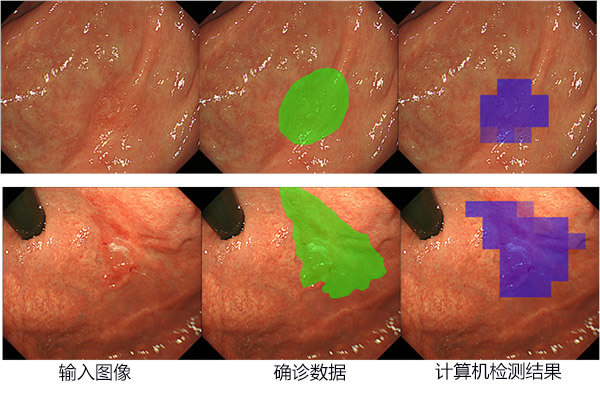 日本研究出早期胃癌檢測方法