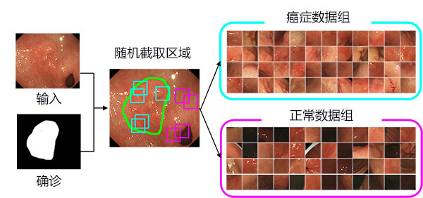日本研究出早期胃癌檢測方法