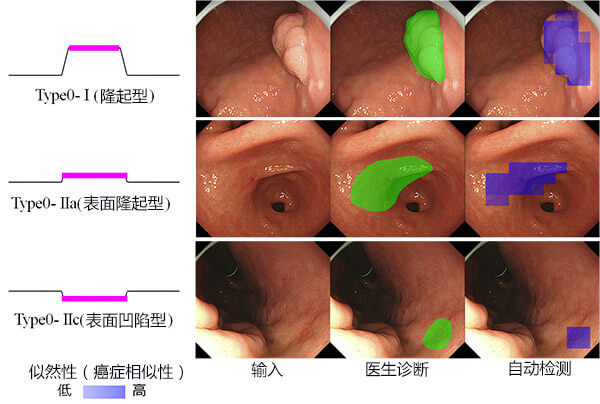 日本研究出早期胃癌檢測方法