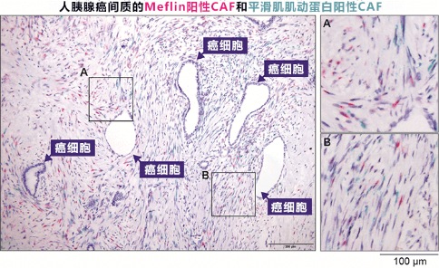 胰腺癌出國治療：這種細(xì)胞竟然可以抑制胰腺癌生長？