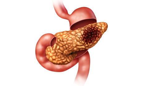 胰腺癌出國(guó)治療：研究發(fā)現(xiàn)胰腺癌轉(zhuǎn)移原因，胰腺癌轉(zhuǎn)移新治療方法或?qū)⒊霈F(xiàn)