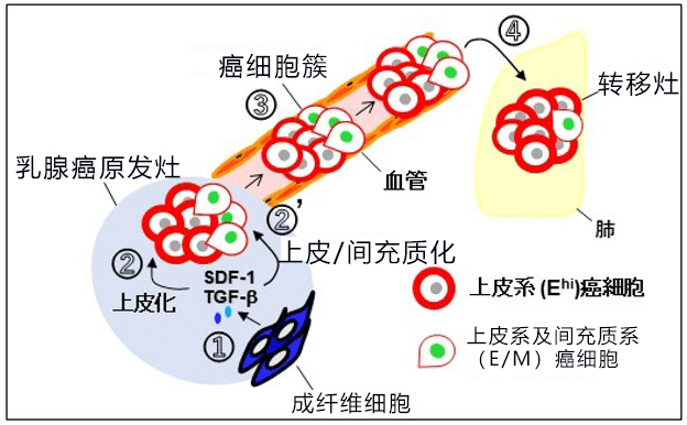乳腺癌出國治療：日本研究人員發(fā)現(xiàn)乳腺癌浸潤轉(zhuǎn)移新機制！