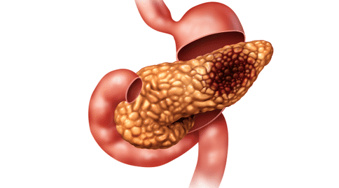 胰腺癌出國治療：真菌微生物與胰腺導(dǎo)管腺癌的發(fā)生具有密切聯(lián)系！