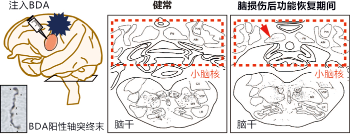 出國看?。貉芯堪l(fā)現(xiàn)大腦損傷后會形成新的神經(jīng)束，或可治療腦部疾病