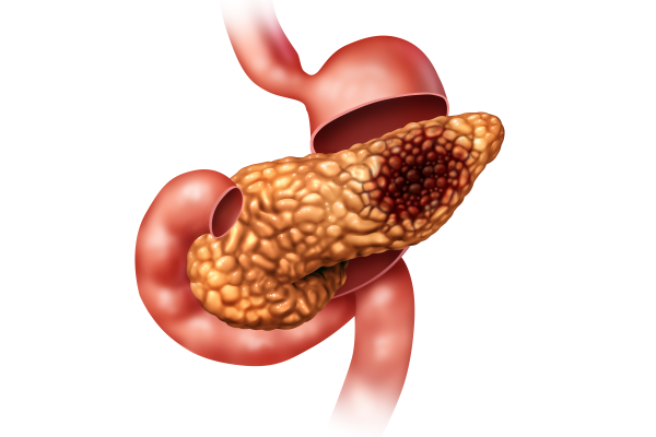 癌癥出國(guó)治療：胰腺癌怎么治療？新研究可為胰腺癌放射治療提供新方向