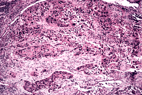新研究闡明了腫瘤中代謝的脆弱性，或對于肺癌治療具有重要作用