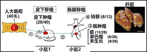 大腸癌轉(zhuǎn)移治療新靶點