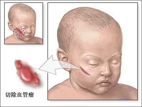 嬰兒血管瘤