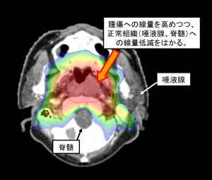 調(diào)強放療治療鼻咽癌