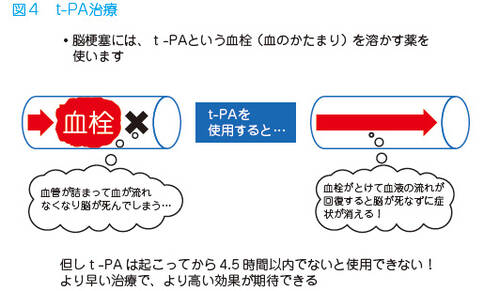 日本紅十字會總醫(yī)院治療腦梗塞的方法