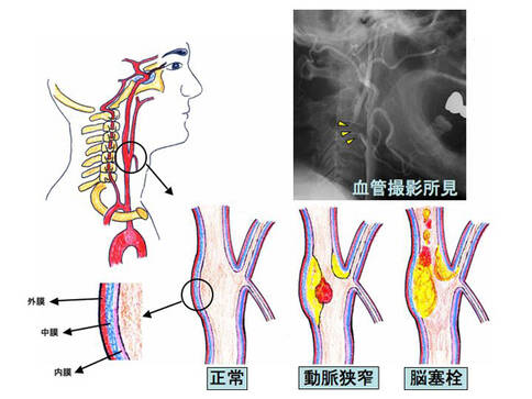 頸動(dòng)脈狹窄