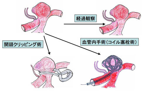 腦血管瘤治療