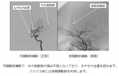 煙霧病治療方法,煙霧病治療,治療煙霧病方法