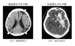 煙霧病治療方法,煙霧病治療,治療煙霧病方法