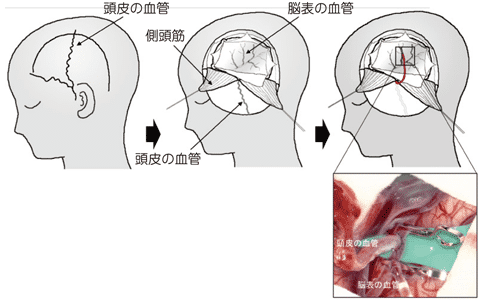日本煙霧病治療方法