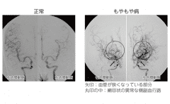 煙霧病治療方法,煙霧病治療,治療煙霧病方法