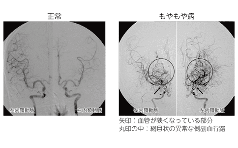 煙霧病治效果果