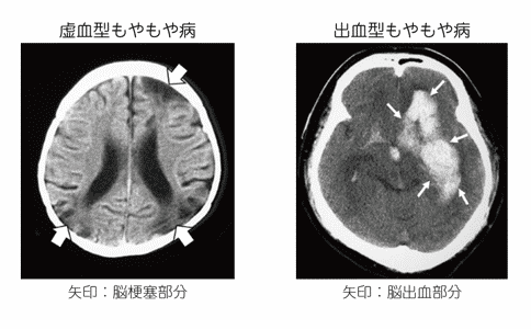 煙霧病預后