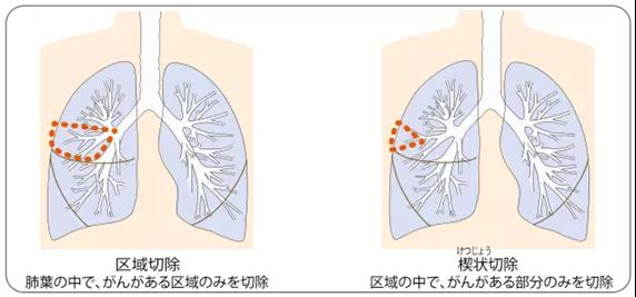 肺癌手術(shù)治療