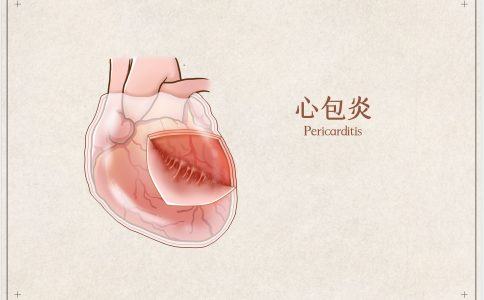 中醫(yī)治療心包炎,心包炎治療方法,心包炎