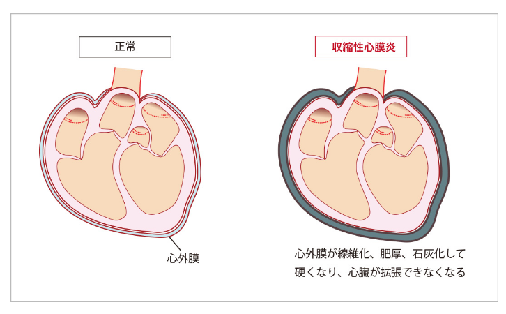 中醫(yī)治療心包炎,心包炎治療方法,心包炎