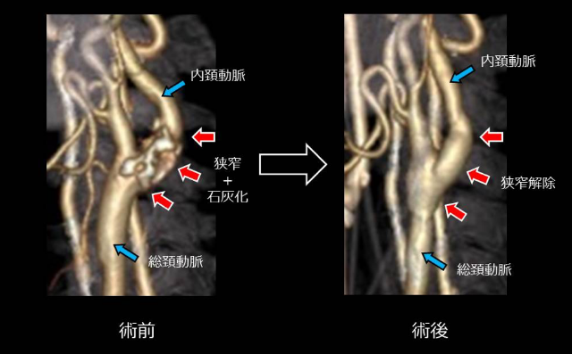 頸動脈斑塊手術(shù)治療
