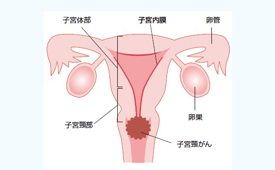 宮頸癌前沿治療