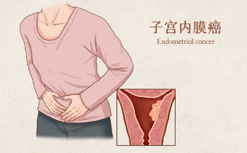 子宮癌前沿治療方法