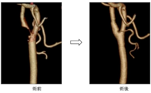 老年人重度頸動(dòng)脈狹窄,頸動(dòng)脈狹窄治療,重度頸動(dòng)脈狹窄治療