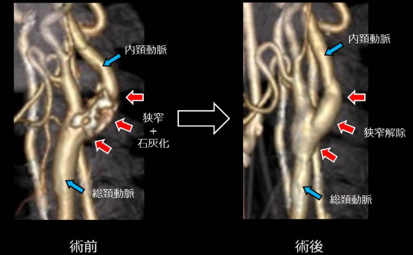 老年人重度頸動(dòng)脈狹窄,頸動(dòng)脈狹窄治療,重度頸動(dòng)脈狹窄治療
