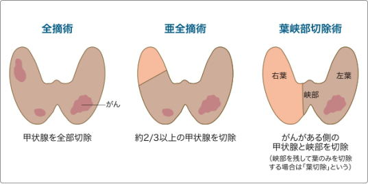 甲狀腺癌治療
