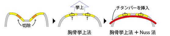 漏斗胸手術治療