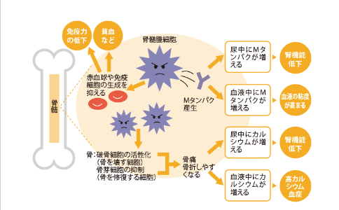 日本治療多發(fā)性骨髓瘤