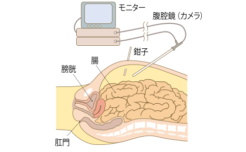 結(jié)直腸癌腹腔鏡手術(shù)