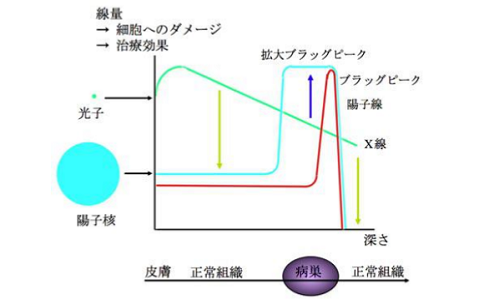 質(zhì)子治療 質(zhì)子治療