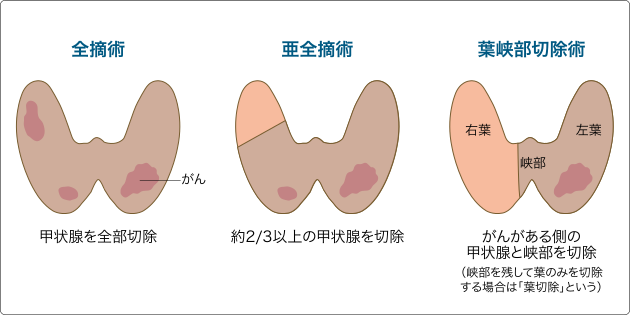 日本甲狀腺癌治療方法