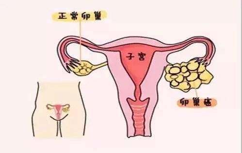 卵巢癌出國(guó)看病靠譜嗎，卵巢癌日本美國(guó)治療的效果