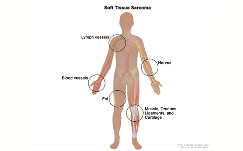 兒童軟組織肉瘤治療 兒童軟組織肉瘤治療