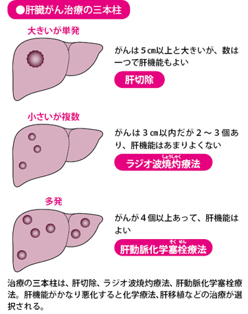 肝癌治療