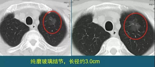 肺磨玻璃結節(jié)